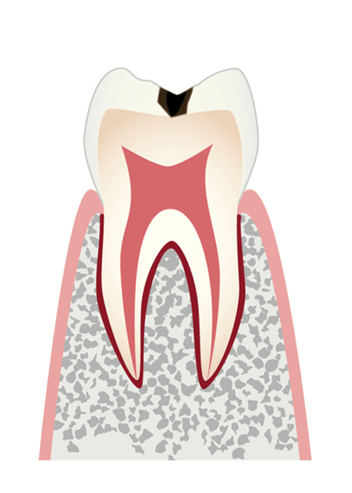 歯の表面のむし歯